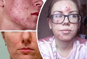 Come sbarazzarsi dell'acne sul viso: consigli di cosmetologi e guaritori popolari